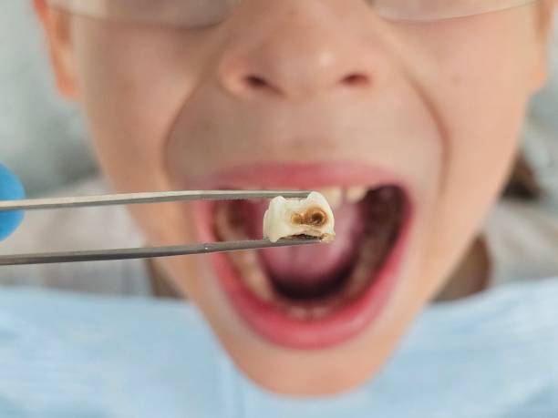 Best Emergency Dentist for Knocked-Out Tooth in Vernon, TX